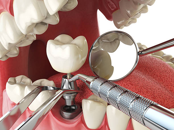 Best Emergency Root Canal Therapy in Spring City, PA