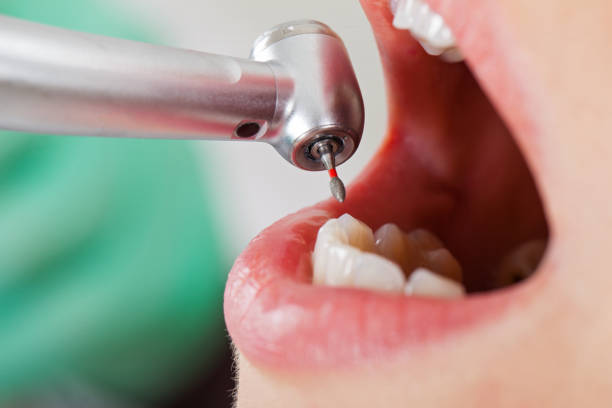 Best Knocked-Out Tooth (Avulsed Tooth) Treatment in Spring City, PA